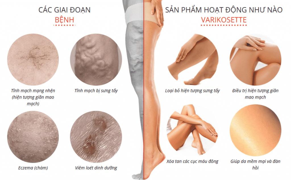 Kem Varikosette điều trị giãn tĩnh mạch 75ml Nga