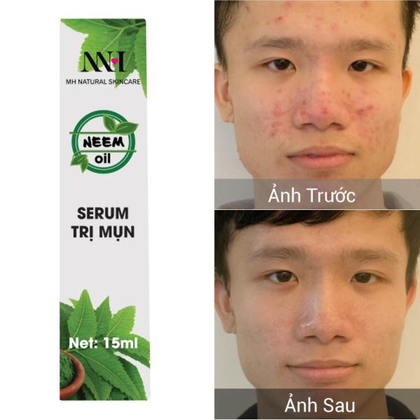 Neem Oil - Serum đặc trị mụn