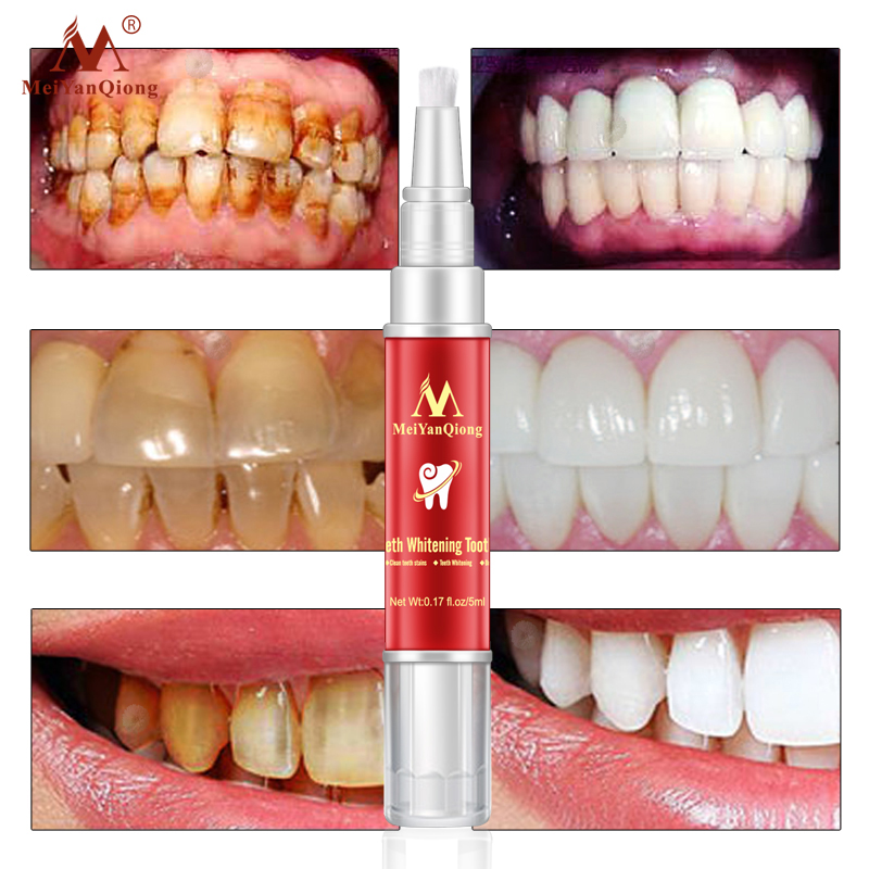 Bút tẩy trắng răng Teeth Whitening Pen