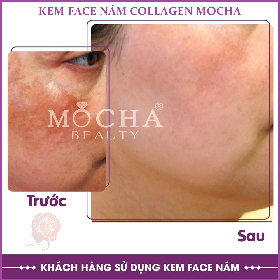 Kem trị nám Face Collagen tảo non Mocha