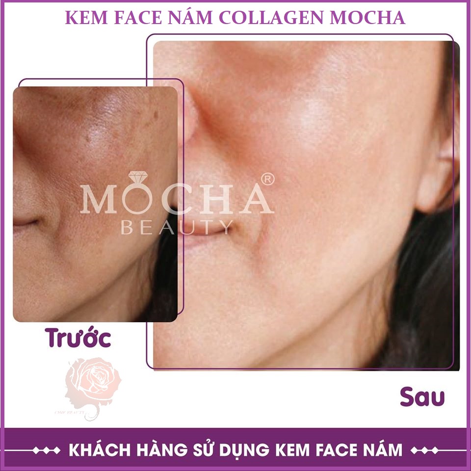 Kem trị nám Face Collagen tảo non Mocha