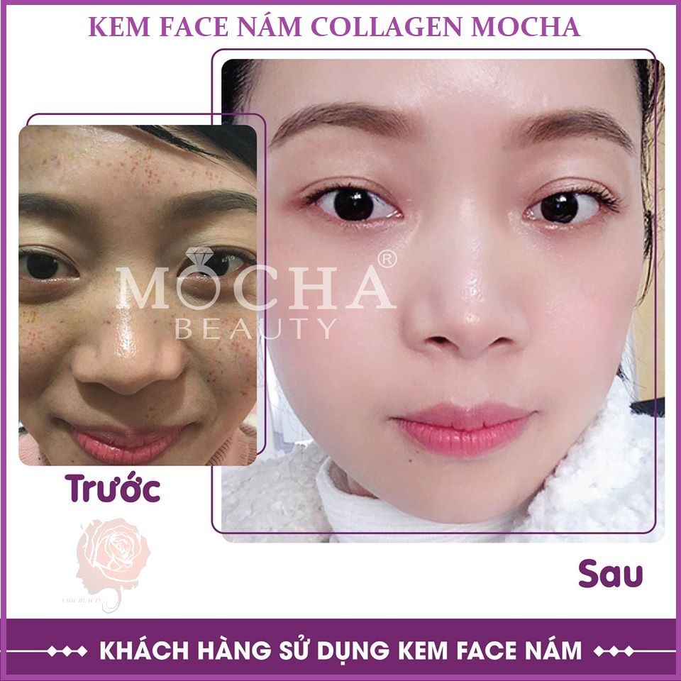 Kem trị nám Face Collagen tảo non Mocha