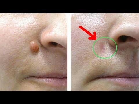 Tẩy nốt ruồi, mụn cóc, mụn cơm, mụn thịt
