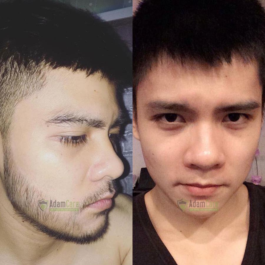[HCM] Serum Mọc Râu Tóc Minoxidil 5% Tặng bột LCLT