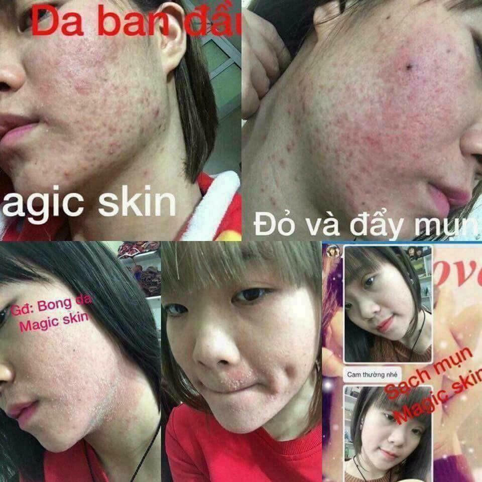 Bộ Ngừa Mụn Đông Y Magic Skin (Full)