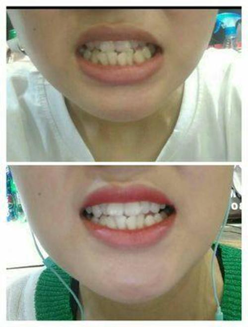 [HCM]DỤNG CỤ NIỀNG RĂNG │Cho Người Lớn- Bộ 3 hàm A1 + A2 + A3