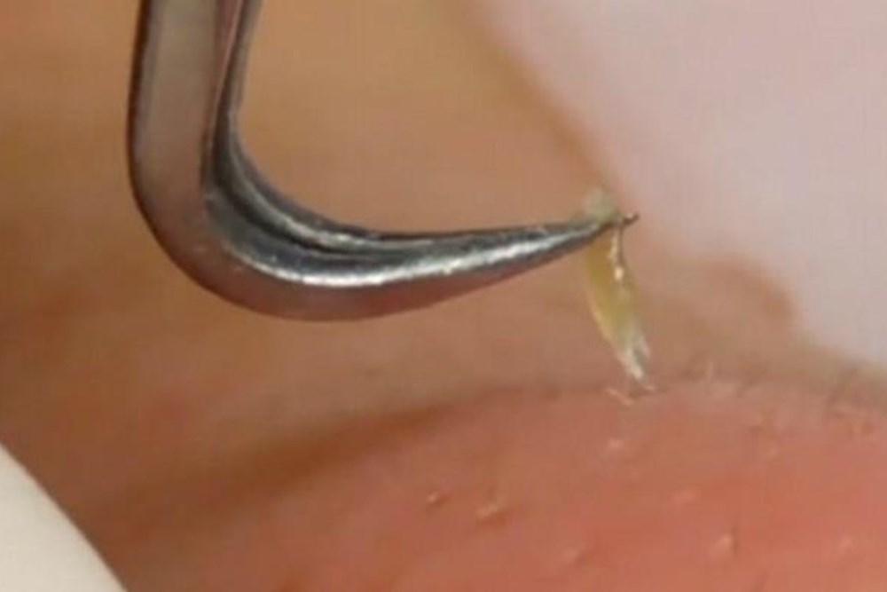Nhíp gắp mụn đầu cong thần thánh (Bạc)