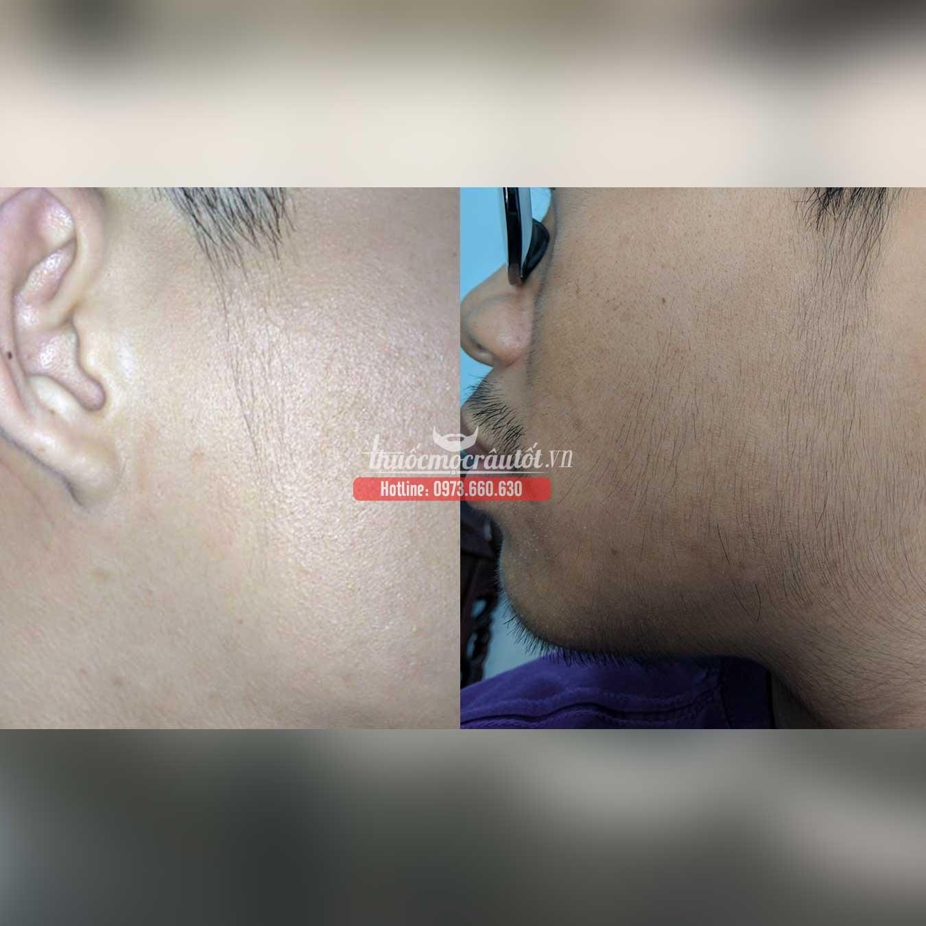 [HCM]Thuốc mọc r&acircu minoxidil 5% dạng bọt