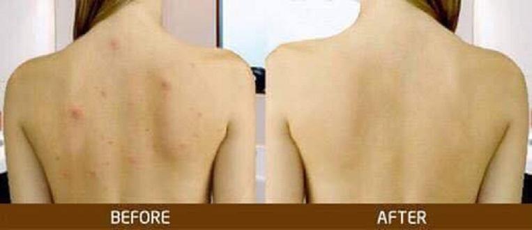 Sữa tắm Aderma hết mụn lưng xách tay Pháp