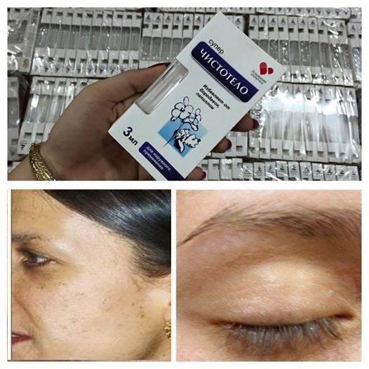 GEL XÓA NỐT RUỒI, THỊT THỪA, MỤN CÓC
