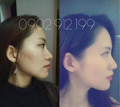 [HCM]Dụng Cụ Niềng Răng Tại Nhà [ Đủ 3 giai đoạn A1+ A2+A3 ]