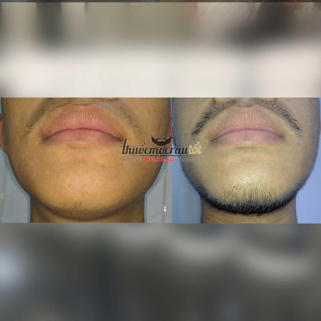 [HCM]Thuốc mọc r&acircu minoxidil 5% dạng bọt