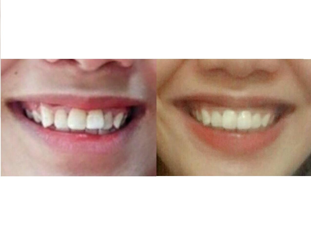[HCM]DỤNG CỤ NIỀNG RĂNG │Thế Hệ Mới 2021 - Bộ 3 hàm A1 + A2 + A3