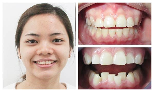 Dụng Cụ Niềng Răng Tại Nhà (Bộ 3 Hàm)