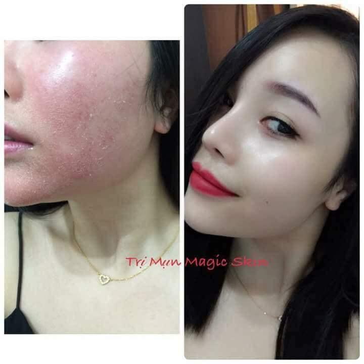 Bộ Ngừa Mụn Đông Y Magic Skin (Full)