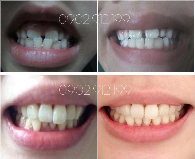 [HCM]Dụng Cụ Niềng Răng Tại Nhà [ Đủ 3 giai đoạn A1+ A2+A3 ]