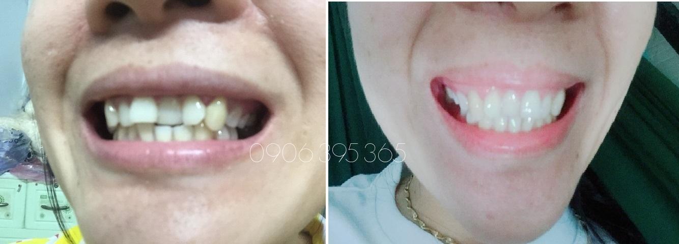 [HCM]DỤNG CỤ NIỀNG RĂNG │Thế Hệ Mới 2021 - Bộ 3 hàm A1 + A2 + A3