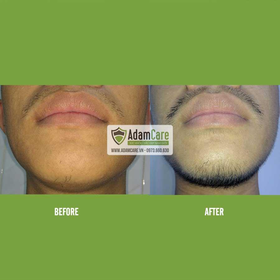 [HCM]Serum mọc râu Minoxidil 5% Foam combo 3