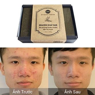 Xà phòng trị mụn cho nam MH 100g