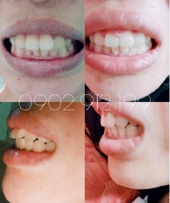 [HCM]Dụng Cụ Niềng Răng Tại Nhà [ Đủ 3 giai đoạn A1+ A2+A3 ]