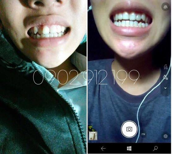 [HCM]DỤNG CỤ NIỀNG RĂNG │Thế Hệ Mới 2021 - Bộ 3 hàm A1 + A2 + A3