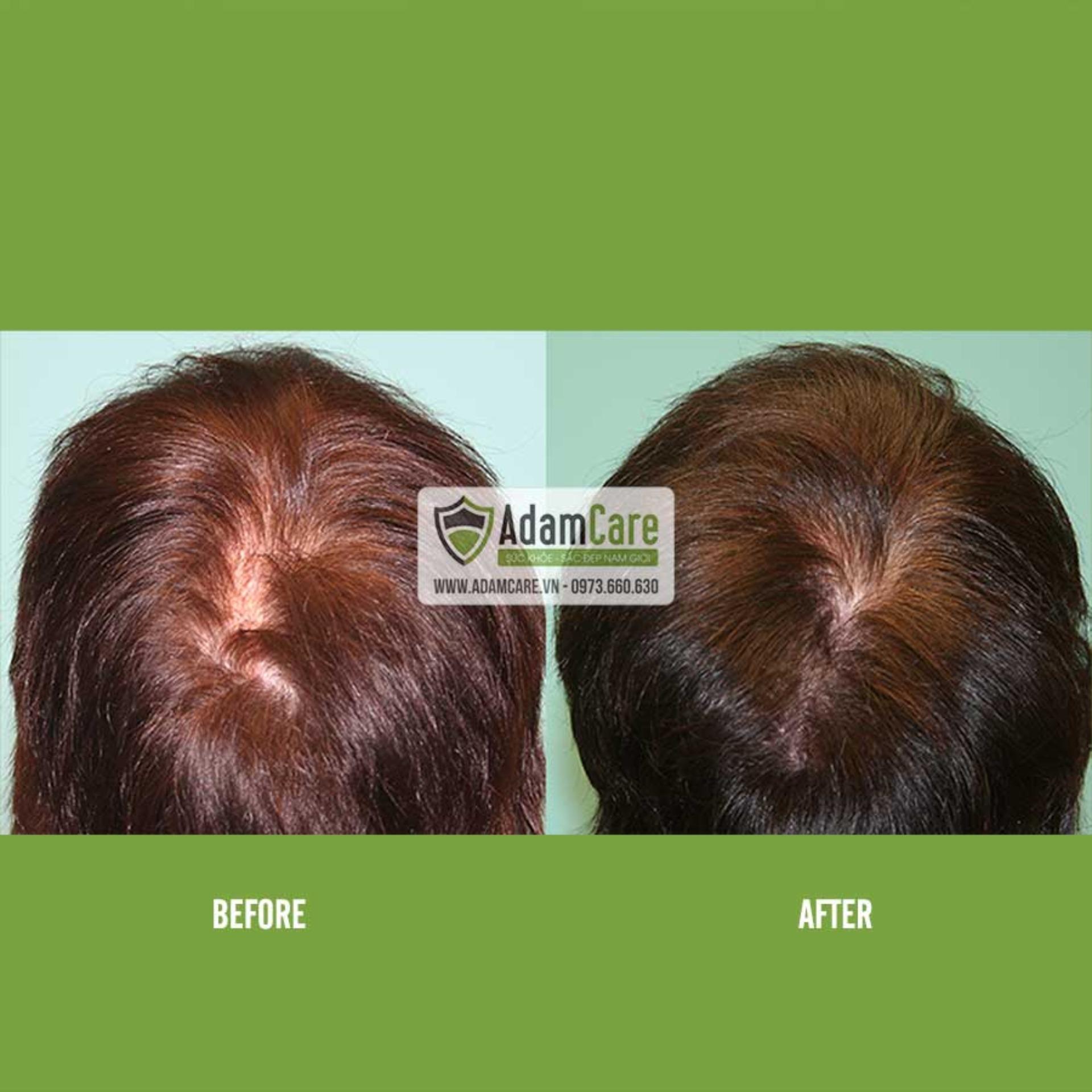 [HCM]Serum mọc tóc Minoxidil 2% cho NỮ