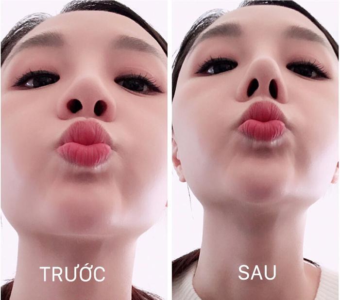 BỘ NÂNG MŨI HÀN QUỐC SIÊU TỰ TIN