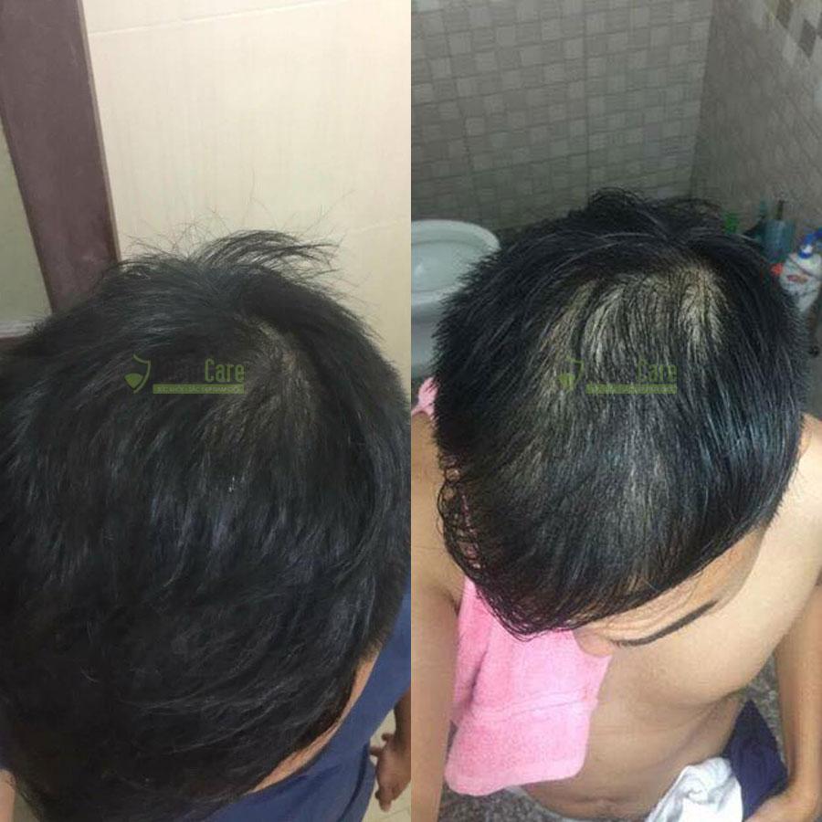 [HCM] Serum Mọc Râu Tóc Minoxidil 5% Tặng bột LCLT