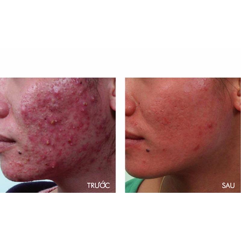 Gel chấm mụn siêu tốc Linh Sâm
