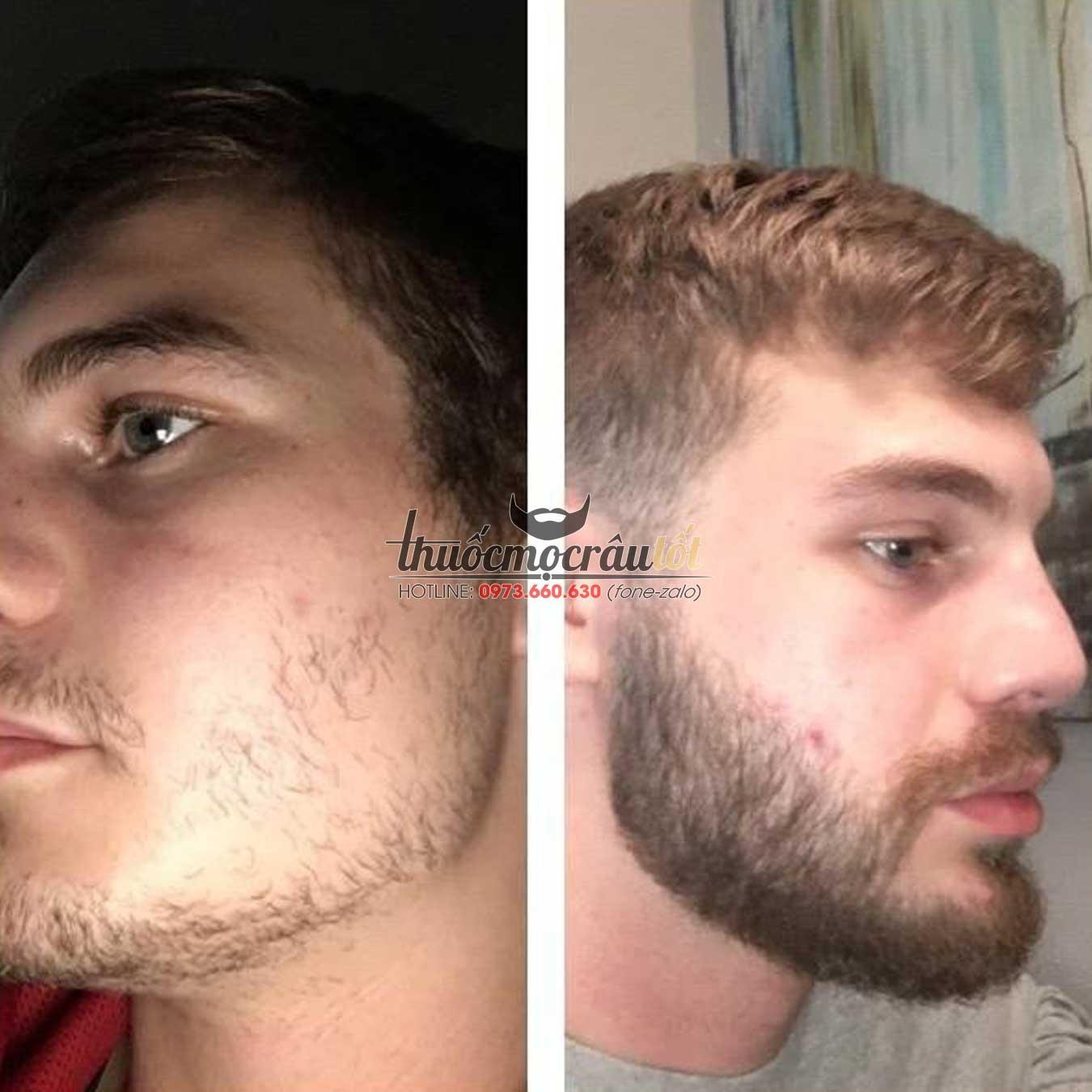 [HCM]Thuốc mọc r&acircu minoxidil 5% dạng bọt