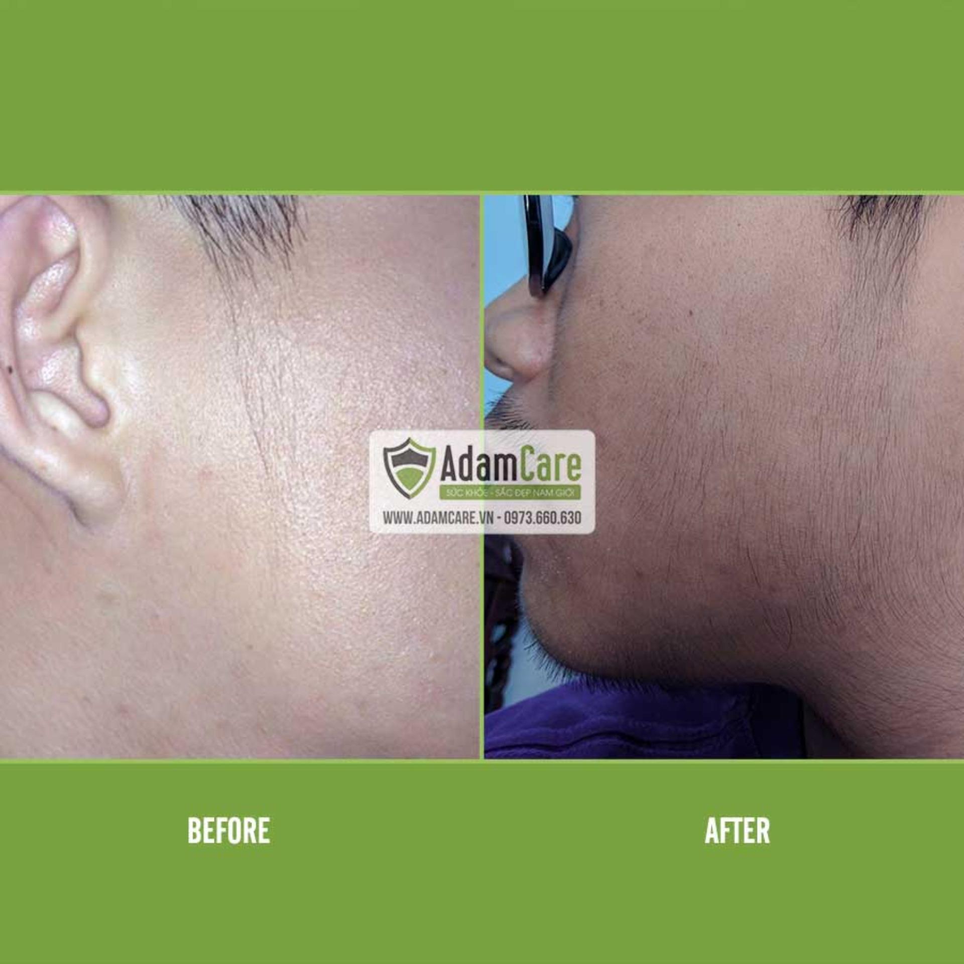 [HCM]Serum mọc râu Minoxidil 5% dạng lỏng combo 2 chai