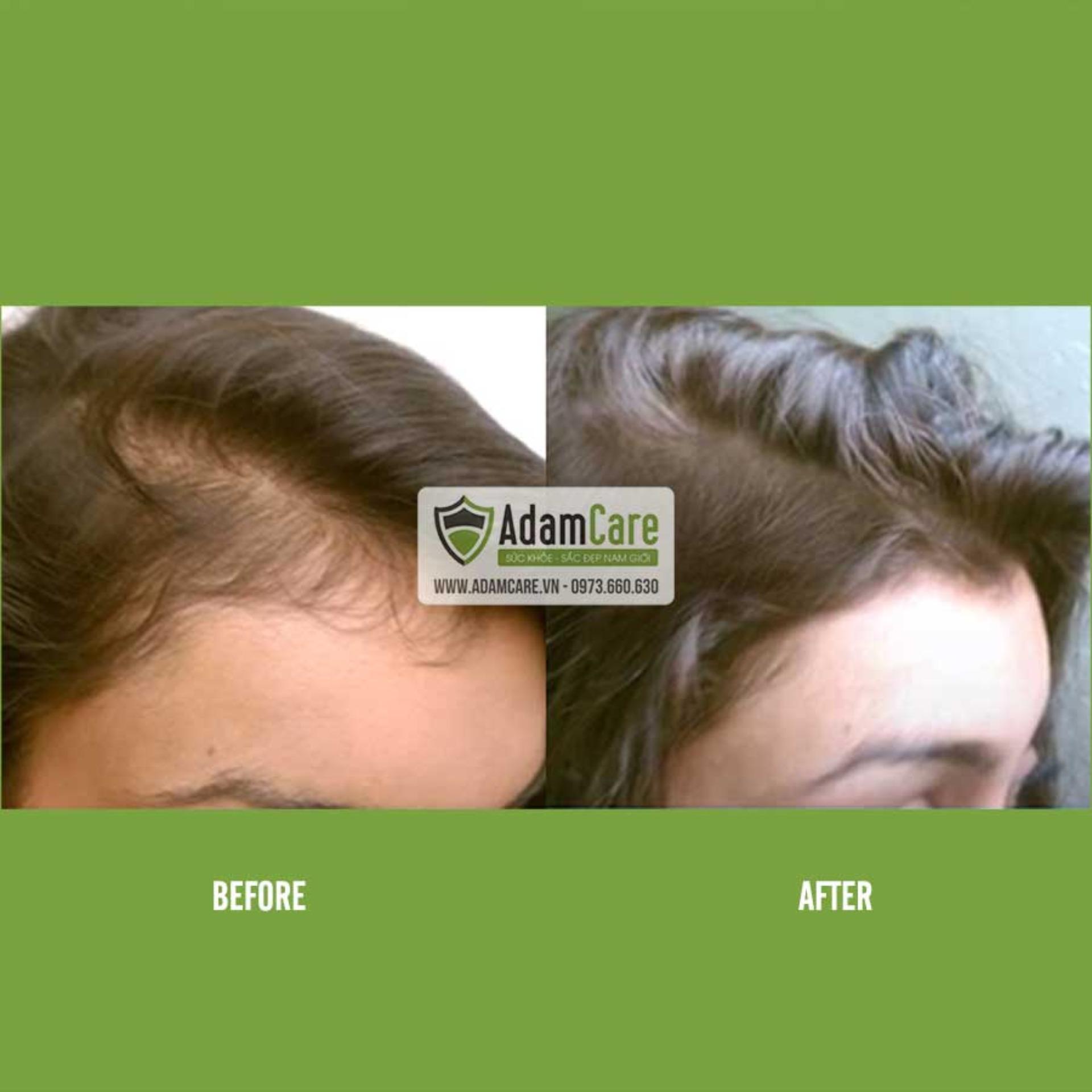 [HCM]Serum mọc tóc Minoxidil 2% cho NỮ