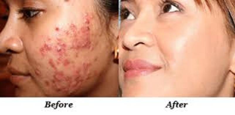KEM MỤN THẢO DƯỢC MẸ KEN-30ml