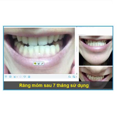 [HCM]DỤNG CỤ NIỀNG RĂNG │Thế Hệ Mới 2021 - Bộ 3 hàm A1 + A2 + A3