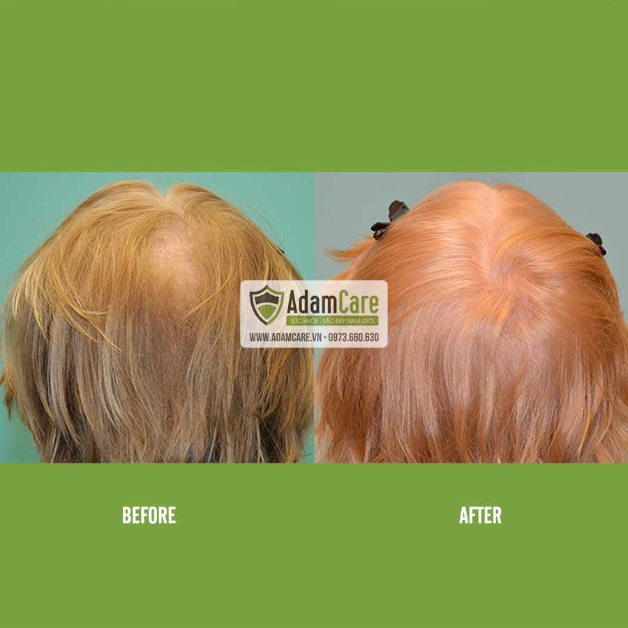 [HCM] Serum mọc tóc Minoxidil 5% dạng lỏng 6 month supply