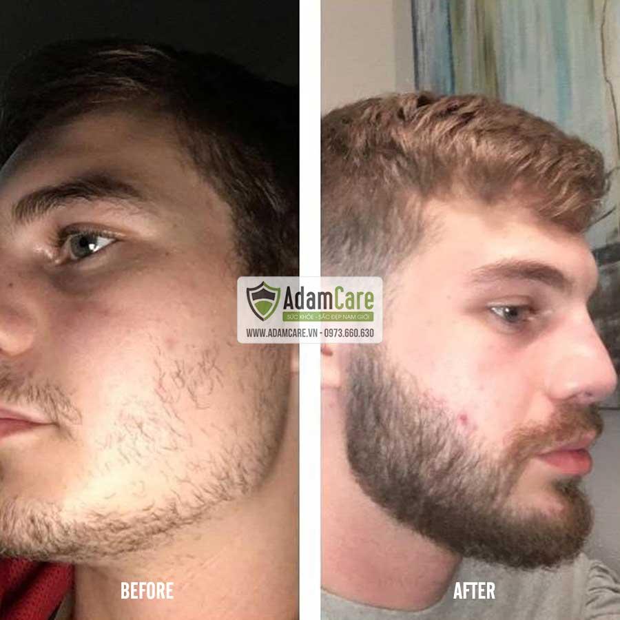 [HCM]Serum mọc râu Minoxidil 5% Foam combo 3