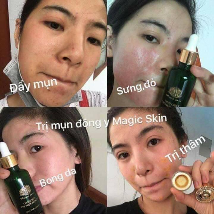 Bộ Ngừa Mụn Đông Y Magic Skin (Full)