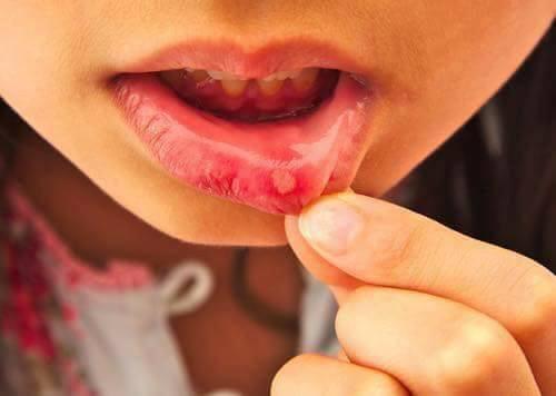 Thuốc xịt trị nhiệt miệng của Nhật