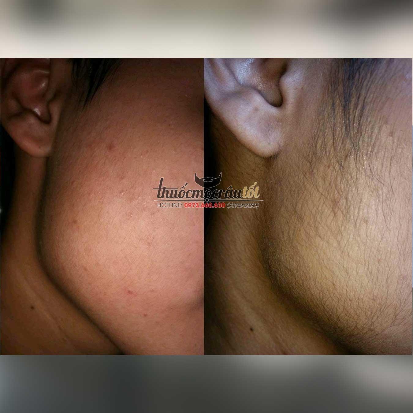 [HCM]Ống hút dung dịch minoxidil 5%