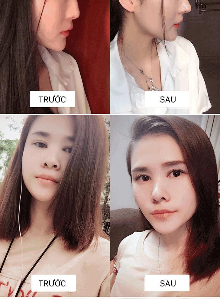 BỘ NÂNG MŨI HÀN QUỐC SIÊU TỰ TIN