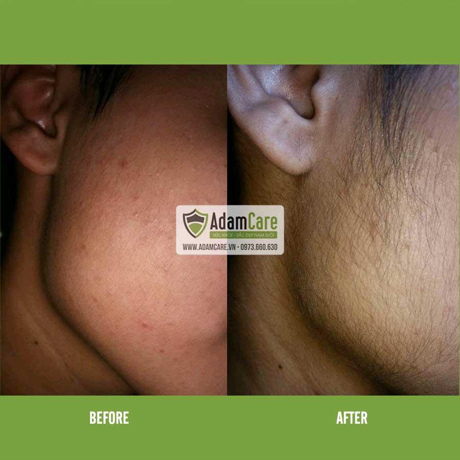 [HCM]Serum mọc râu Minoxidil 5% Foam combo 3