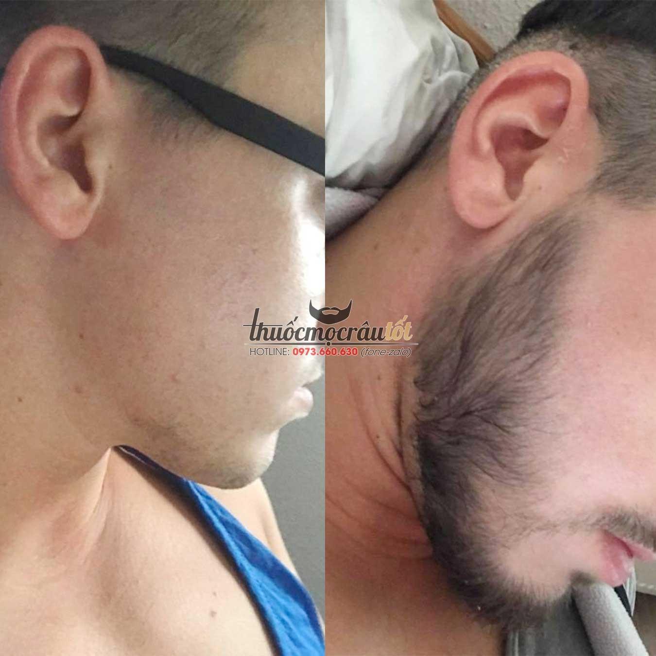 [HCM]Thuốc mọc r&acircu minoxidil 5% dạng bọt