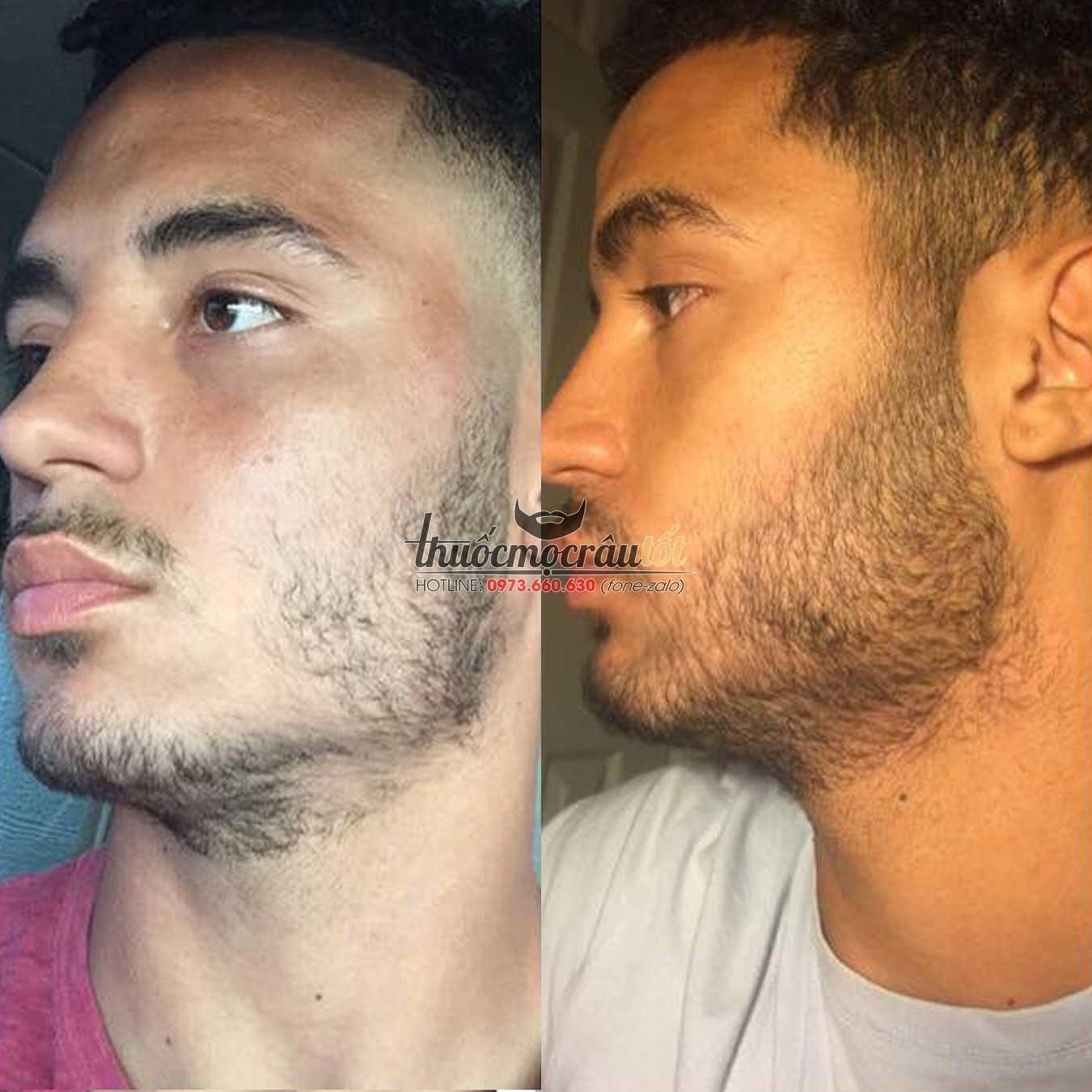 [HCM]Thuốc mọc r&acircu minoxidil 5% dạng bọt