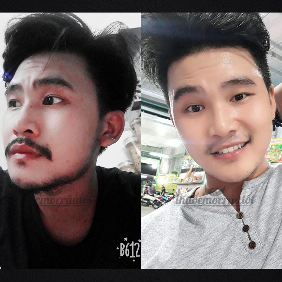 Thuốc mọc râu Kirkland của Mỹ