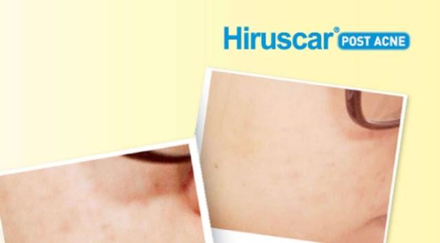Kem hỗ trợ trị sẹo Hiruscar 5g