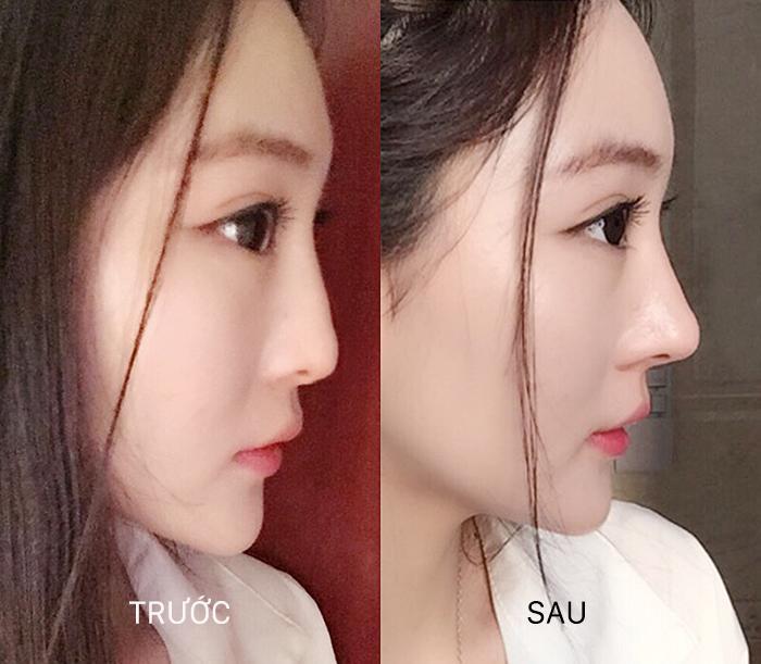 BỘ NÂNG MŨI HÀN QUỐC SIÊU TỰ TIN