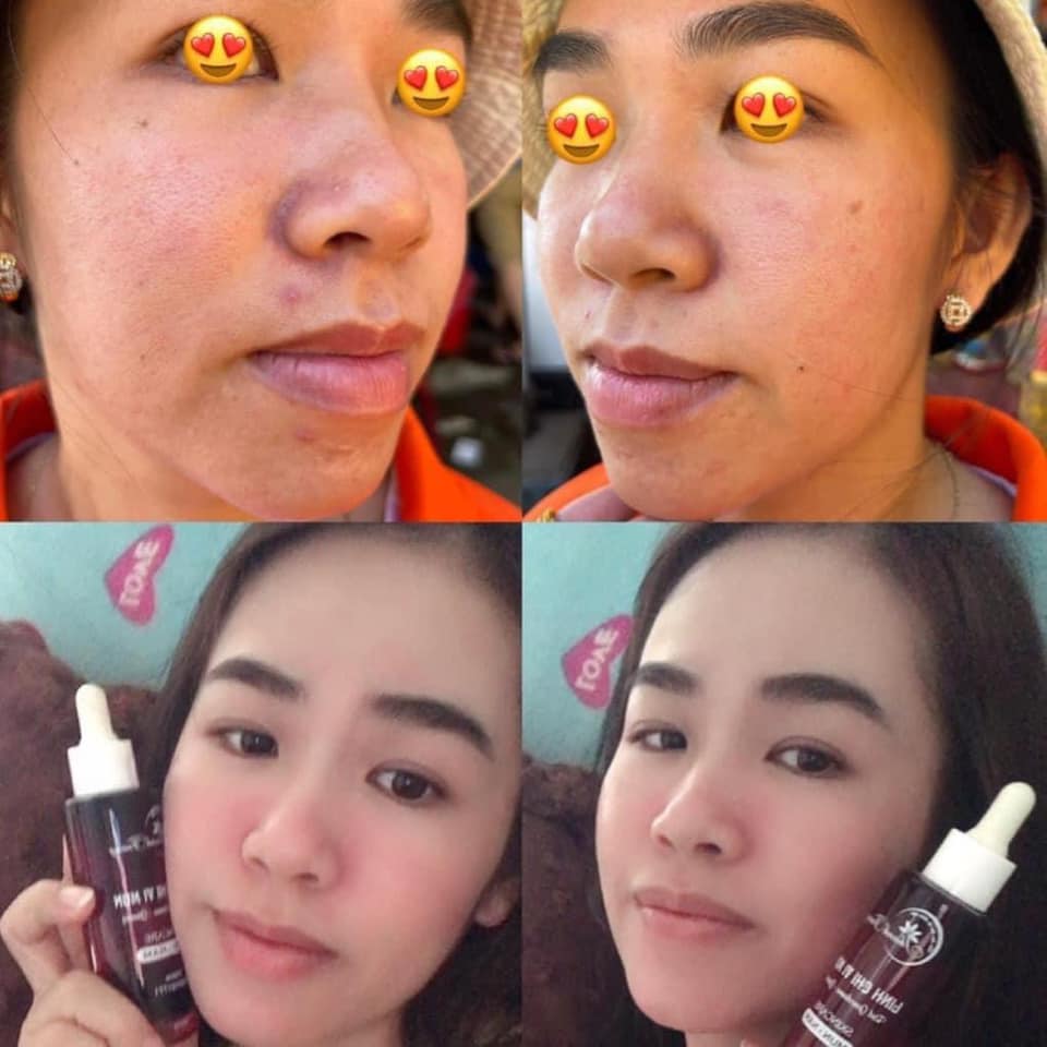 Linh chi vi mụn