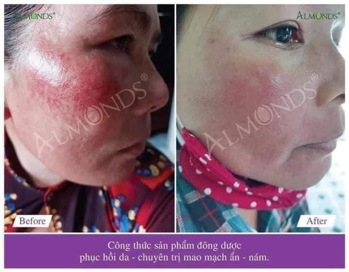 [HCM]KEM TR.I. GIÃN MAO MẠCH - THẠCH SÂM ĐỎ