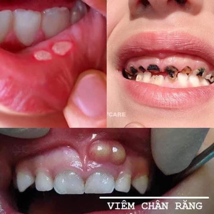 THUOC Đ.Ặ.C TR.Ị SÂU RĂNG PHÚ ÂN - CAM KẾT KHỎI DỨT ĐIỂM BỆNH RĂNG MIỆNG - NPP PIONE BOSS điều tr.ị sâu răng, sún răng, nhiệt miệng, hôi miệng, nấm lưỡi, viêm lợi, chảy máu chân răng...