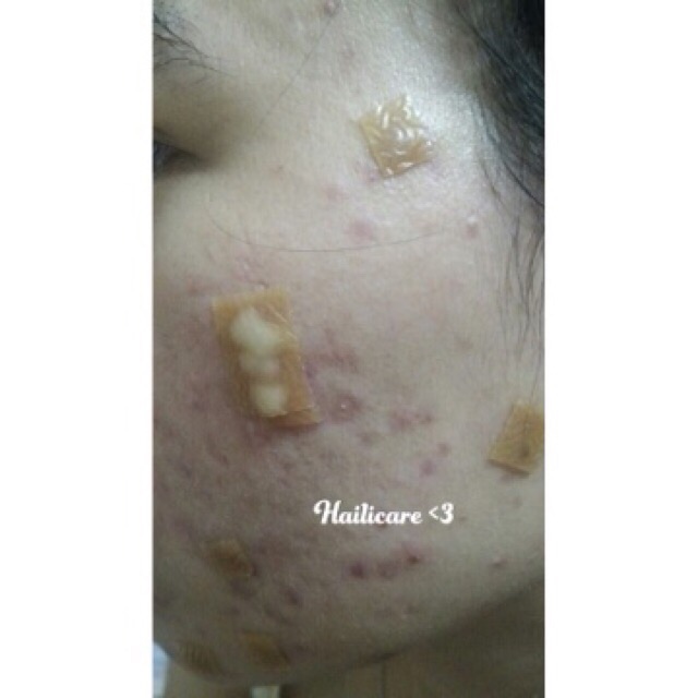 1 Miếng Dán Nhanh Xẹp Mụn DuoDerm Extra Thin